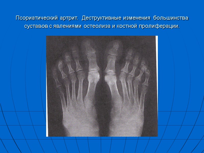Псориатический артрит. Деструктивные изменения большинства суставов с явлениями остеолиза и костной пролиферации.